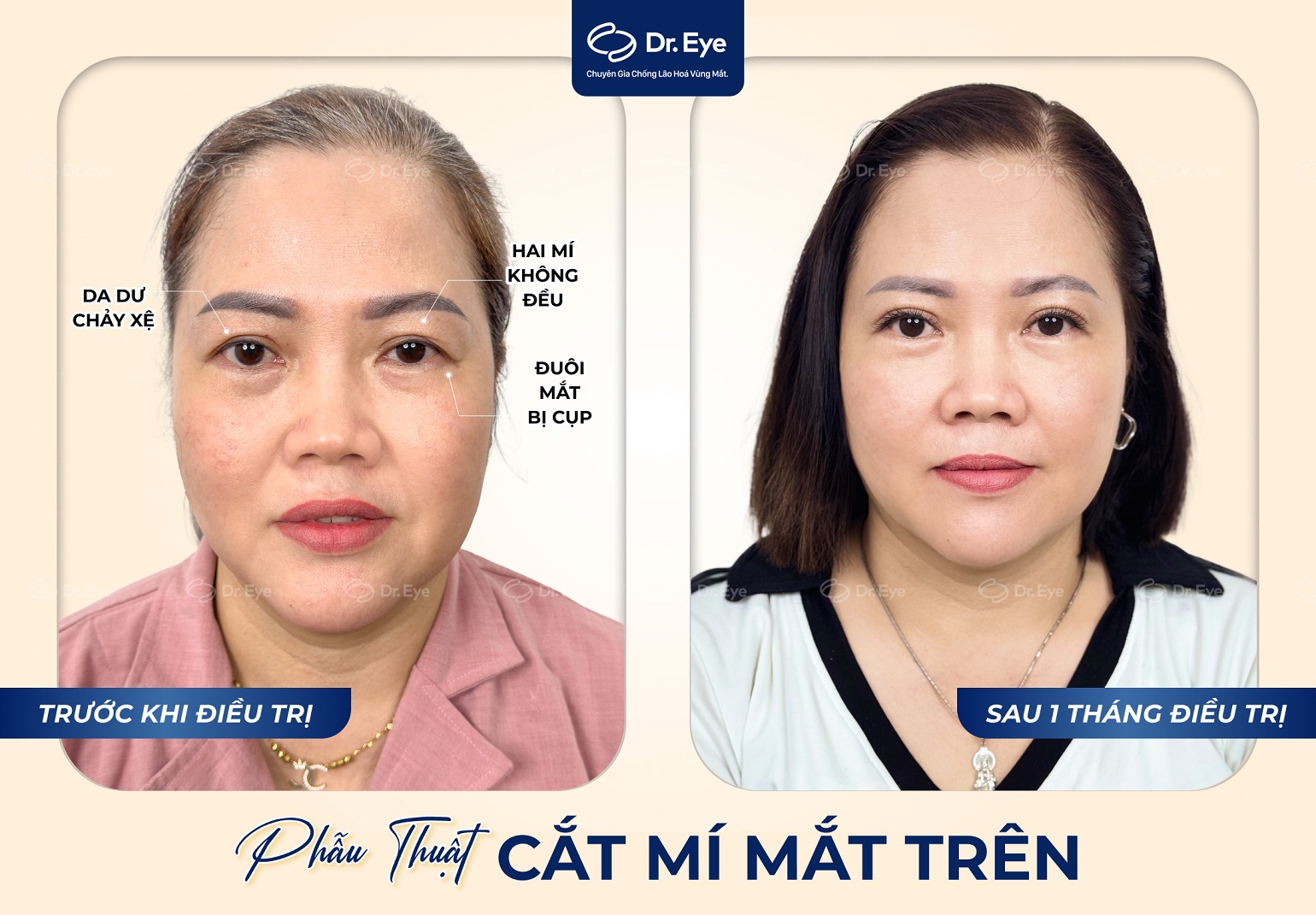 Kết quả cắt mí mắt tại Dr. Eye – Đôi mắt to tròn tự nhiên sau điều trị